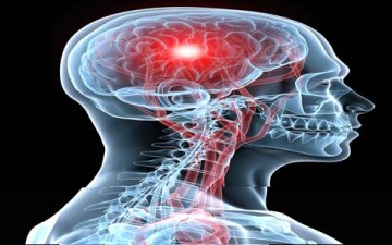 10 نصائح طبيعية للوقاية من السكتة الدماغية