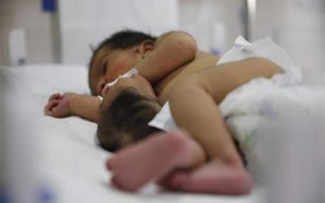 ولادة طفلة برأس ثان في معدتها